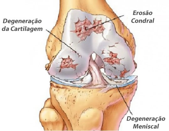 Osteoartrose do joelho